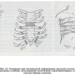 Как исправить килевидную деформацию грудной клетки?