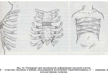 Как исправить килевидную деформацию грудной клетки?