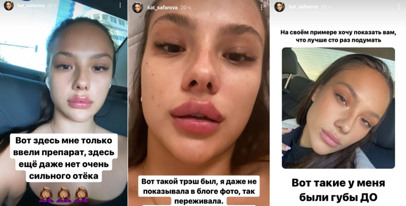 Бывшая девушка Тимати модель Сафарова показала на фото, как ей изуродовали лицо